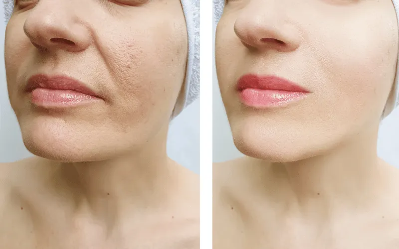 Крупный план улучшения текстуры кожи после бустерной терапии Rejuran Skin