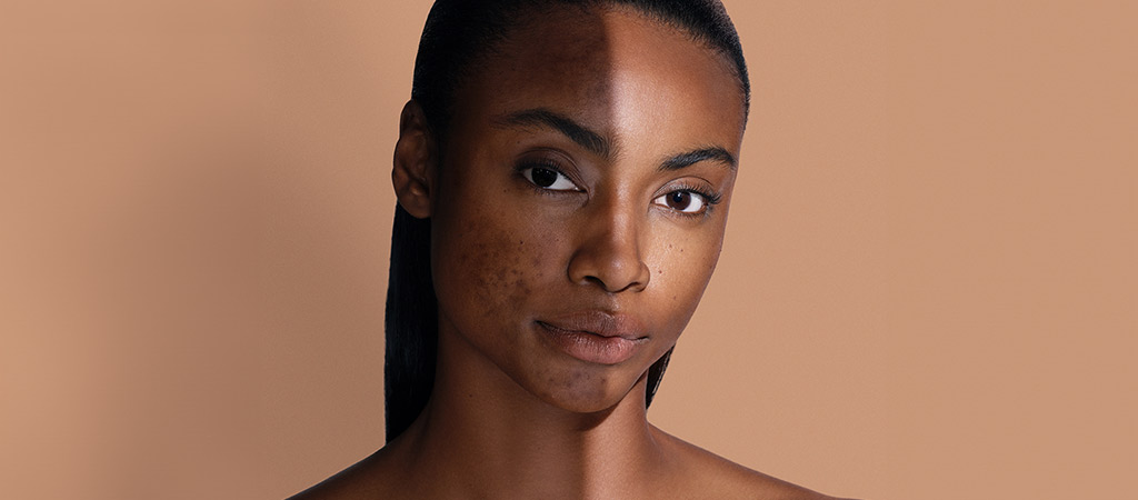 Best acne scar removal plan