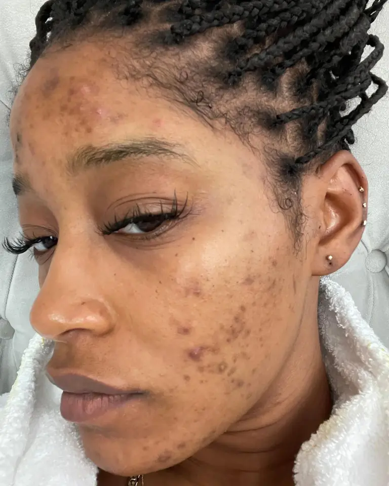 Hydroquinone For Dark Spots: What You Need To Know Before Using It