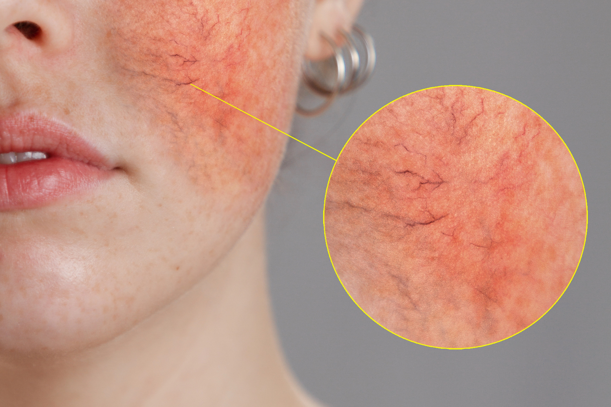 rosacea